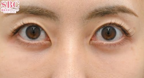 【女性・目元】目の下の切らないクマ・たるみ（ふくらみ）取り、ナチュラル脂肪注射コンデンスリッチ、ナチュラル脂肪注射ナノリッチ_after