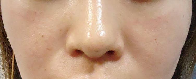 大西皮フ科形成外科医院 滋賀大津石山院でを受けたmoosanさんの写真