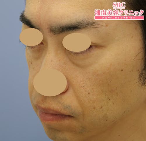 【男性・輪郭】ナチュラル脂肪注射コンデンスリッチ、シークレットリフト_before