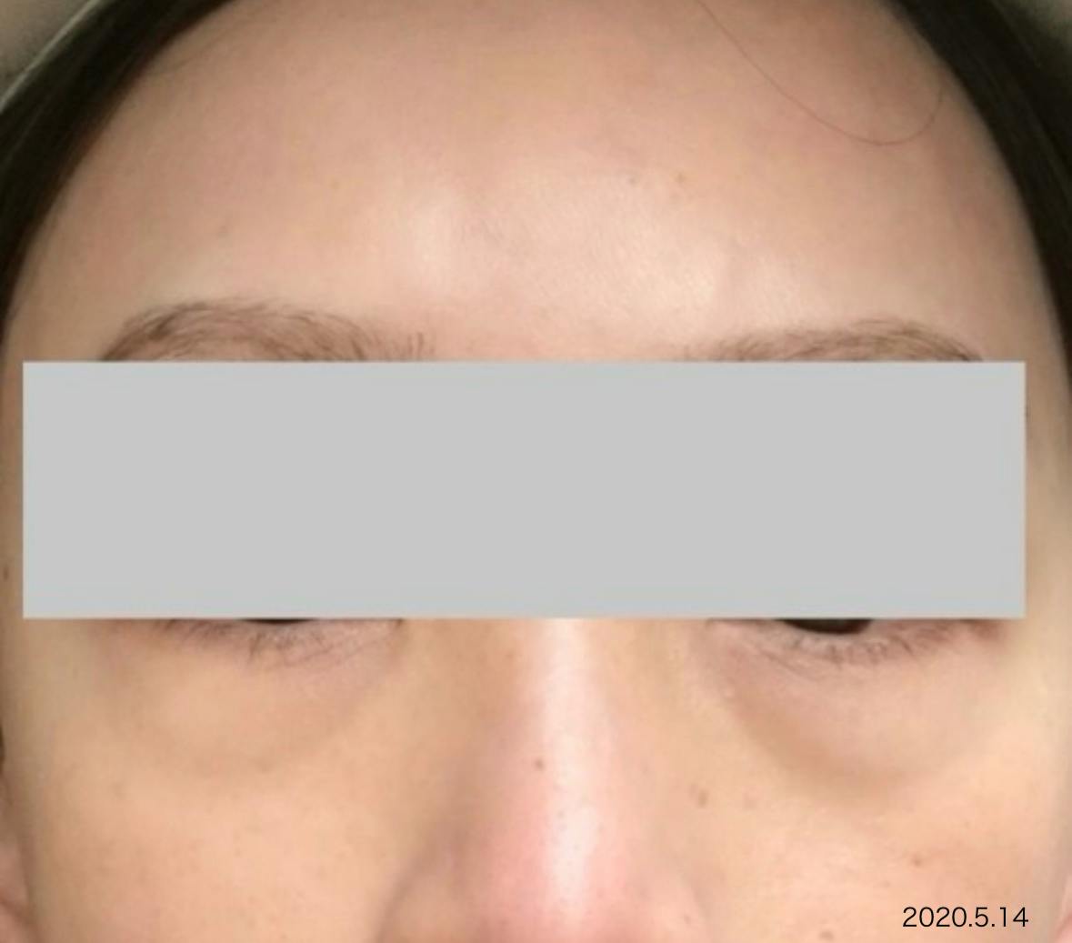 湘南美容クリニック 品川院で目の下のくまとりを受けたarai03さんの写真