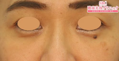 【女性・目元】目の下の切らないクマ・たるみ（ふくらみ）取り、ナチュラル脂肪注射_aftar