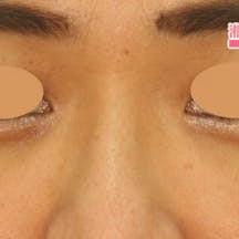 【女性・目元】目の下の切らないクマ・たるみ(ふくらみ)取り、ナチュラル脂肪注射_aftar