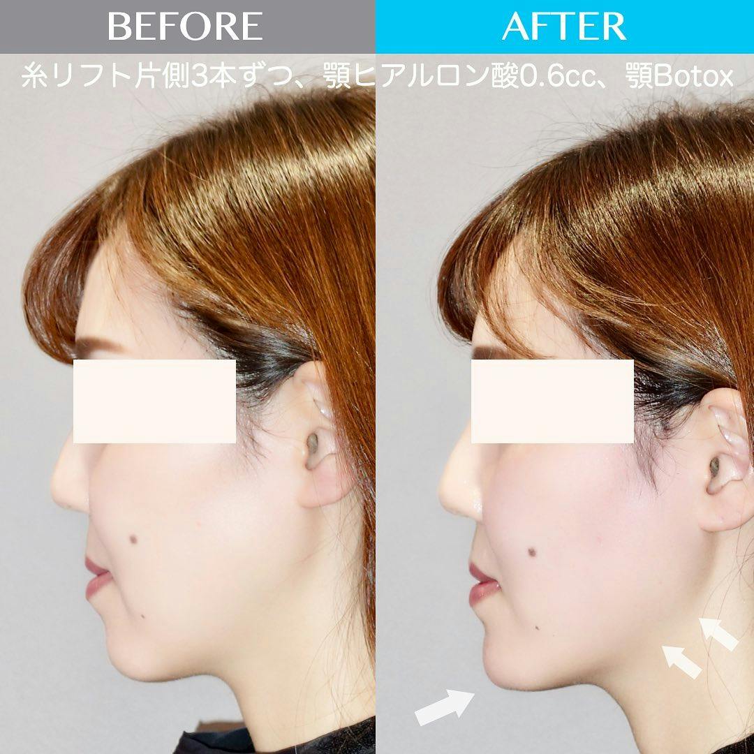 【女性・輪郭】糸リフト、あごヒアルロン酸、ボトックス_before_aftar