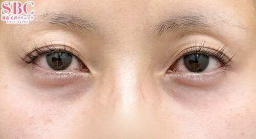 【女性・目元】目の下の切らないクマ・たるみ（ふくらみ）取り、ナチュラル脂肪注射コンデンスリッチ、ナチュラル脂肪注射ナノリッチ_before