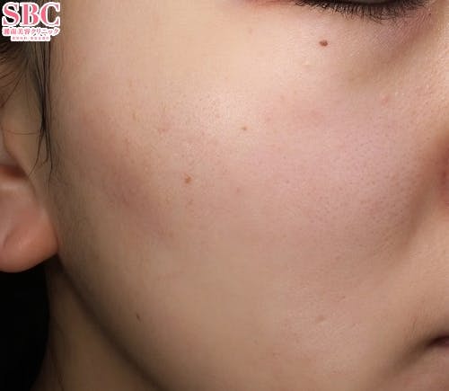 【女性・肌】ヒアルロン酸 ヒアルロン酸ジュビダームビスタ バイクロスシリーズ_after