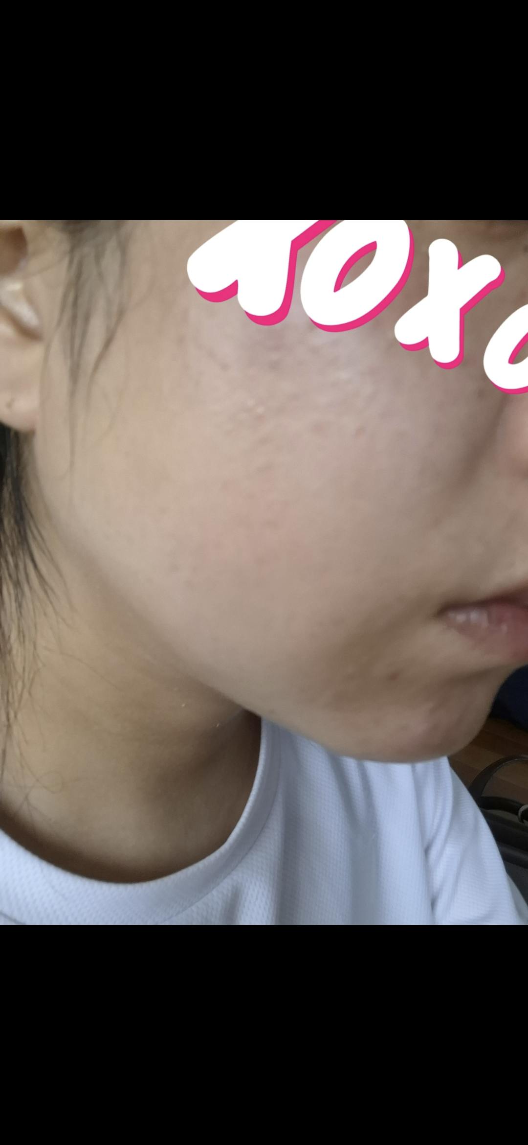 品川スキンクリニック岡山院でコラーゲンピールを受けたマチルダさんの写真