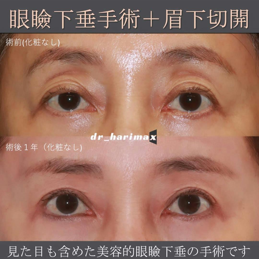 【女性・目】美容的眼瞼下垂手術_before_aftar