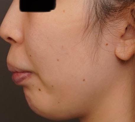 東京美容外科 銀座院で耳の施術：ピアス穴閉じを受けたmondさんの写真