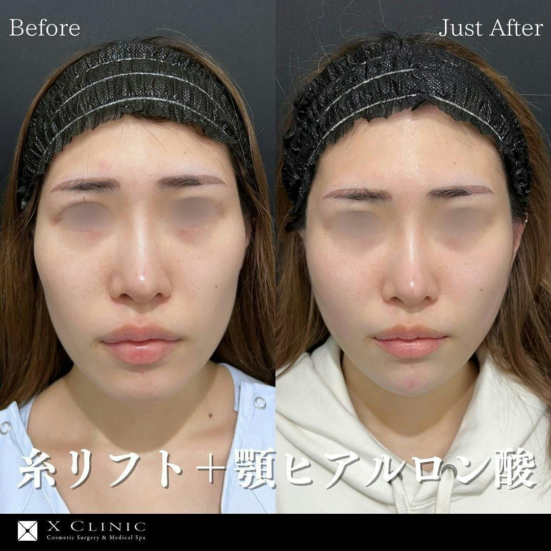 【20代女性・たるみ】糸リフト 顎ヒアルロン酸_before_aftar