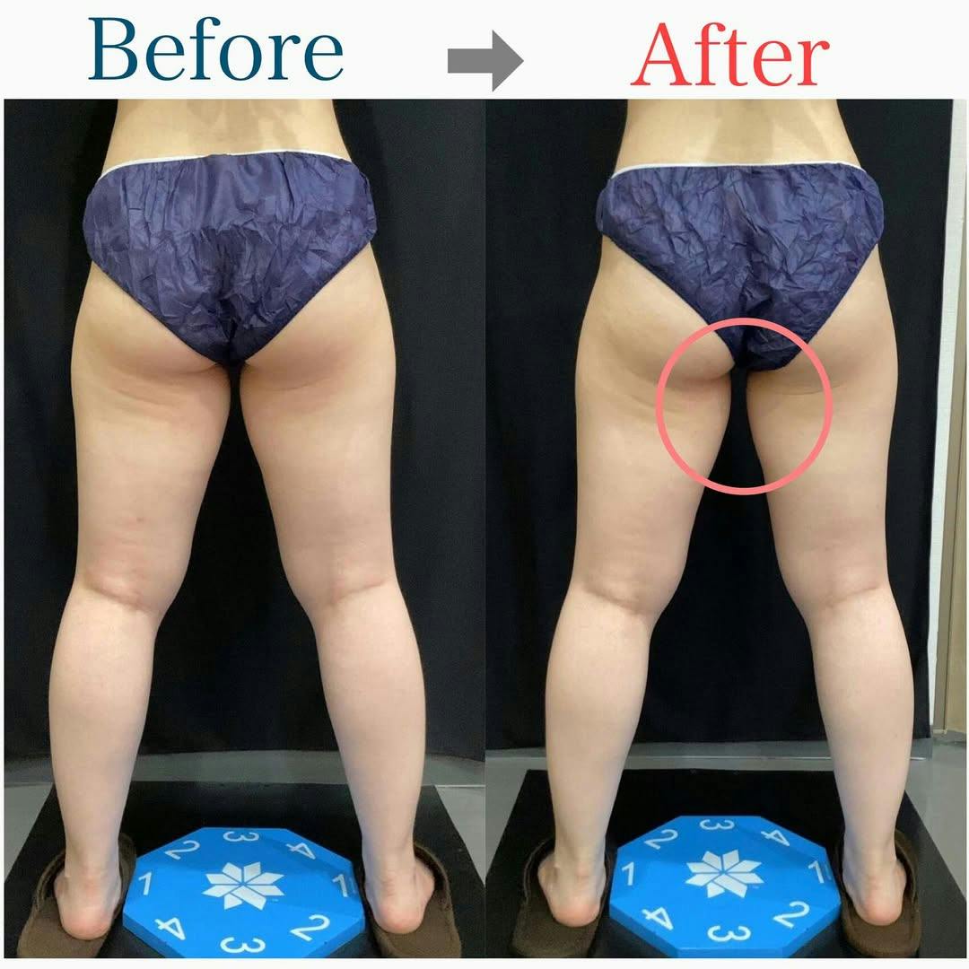 【女性・内腿】クールスカルプティング_before_aftar