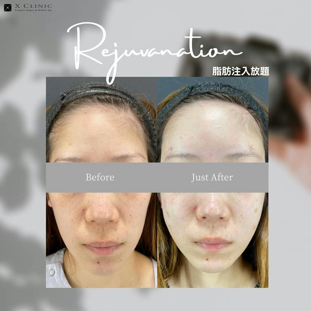 【女性・輪郭】脂肪注入放題_before_aftar