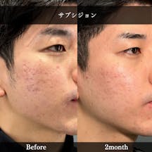 【20代男性・顔のニキビ跡】サブシジョン_before_aftar