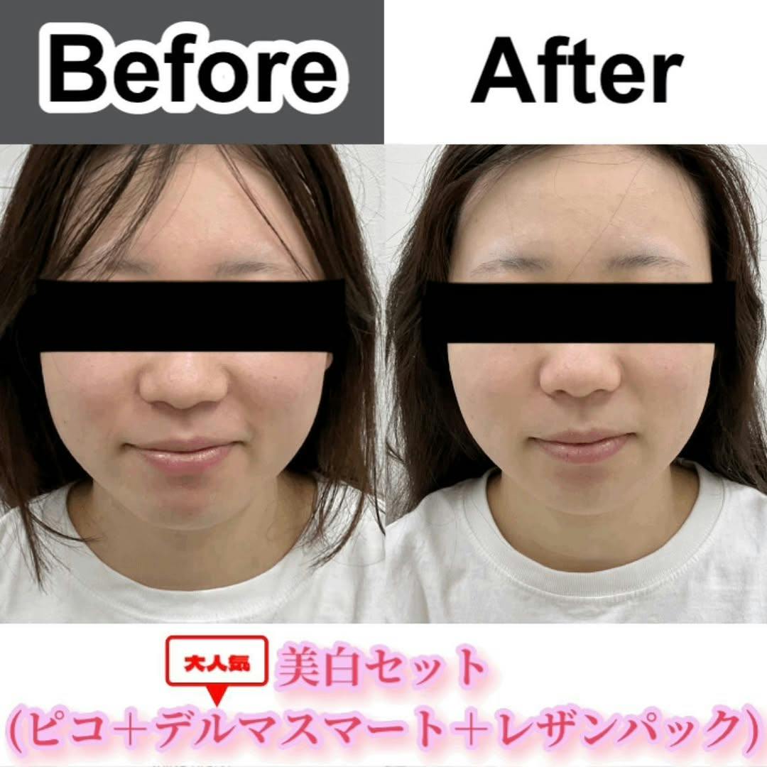 【女性・肌】美白セット（ピコトーニング＋水光注射デルマスマート＋レザンパック(鼻毛穴ケア付)）_before_aftar