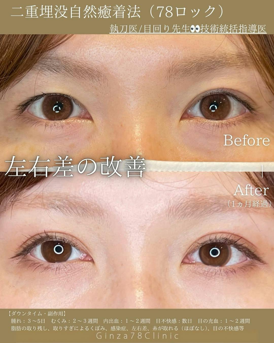 【女性・目元】二重整形(78ロック法)_before_aftar