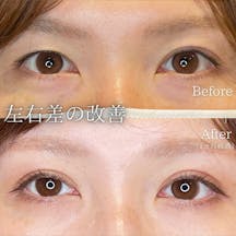 【女性・目元】二重整形(78ロック法)_before_aftar