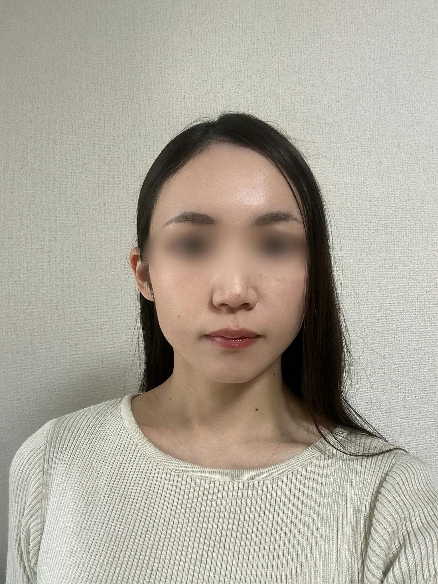 TCB東京中央美容外科 姫路院でボトックス注射・エラボトックス注射(小顔)・韓国製ボトックス・ボツリヌストキシン・ボトックス注射・ボトックス注射(顎)・目尻ボトックス注射・眉間ボトックス注射・目の下ボトックス注射・おでこ(額)ボトックス注射・バニーライン・鼻根ボトックス注射・韓国製ボトックス・ボツリヌストキシンを受けたrionさんの写真