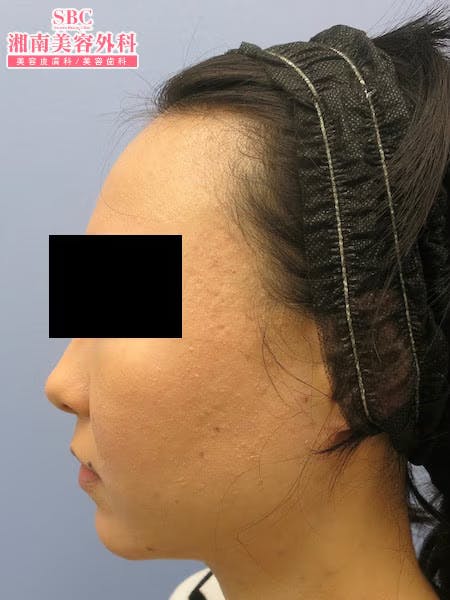 【女性・顔】根こそぎVASER脂肪吸引・ライポマティック脂肪吸引_aftar