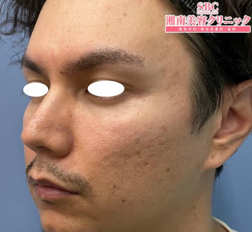 【30代男性・クマ】目の下の切らないクマ・たるみ（ふくらみ）取り_after