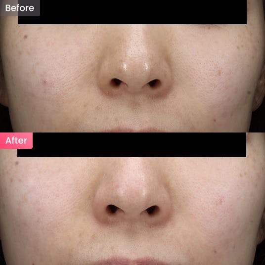 【女性・毛穴】開いた毛穴やテカリが気になるの写真