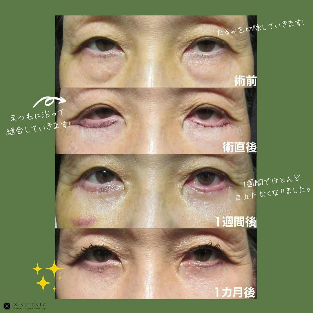 【女性・目元】クマ取りフルコース 余剰皮膚切除_before_aftar