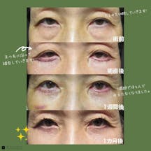 【女性・目元】クマ取りフルコース 余剰皮膚切除_before_aftar