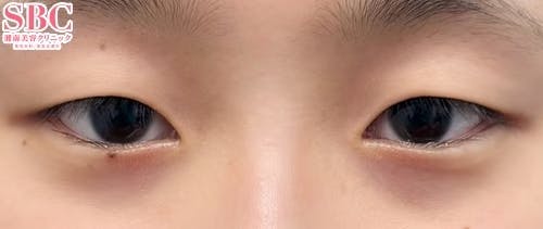 【50代女性・目元】目の下の切らないクマ・たるみ（ふくらみ）取り、ナチュラル脂肪注射ナノリッチ、ナチュラル脂肪注射コンデンスリッチ_before