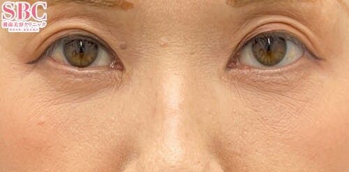 【50代女性・目元】アイバックリムーブ法、ナチュラル脂肪注射コンデンスリッチ、ナチュラル脂肪注射ナノリッチ_after