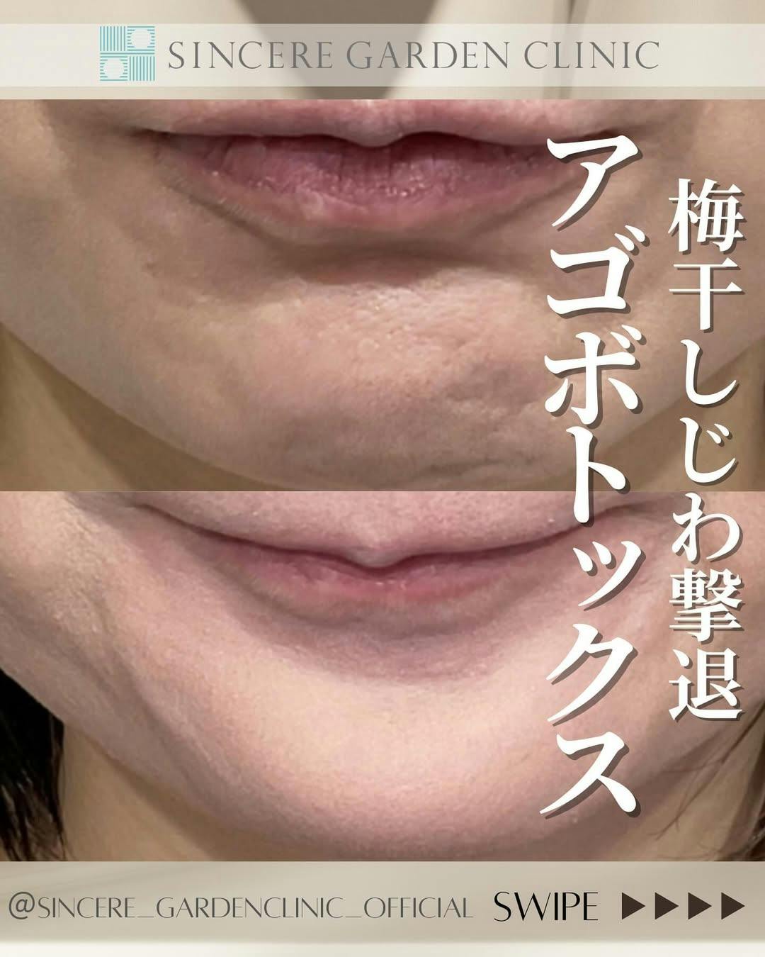 【女性・シワ】アゴボトックス_before_aftar