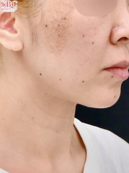 【女性・輪郭】エンブレイスRF・Aquicell（アキーセル）脂肪吸引_aftar