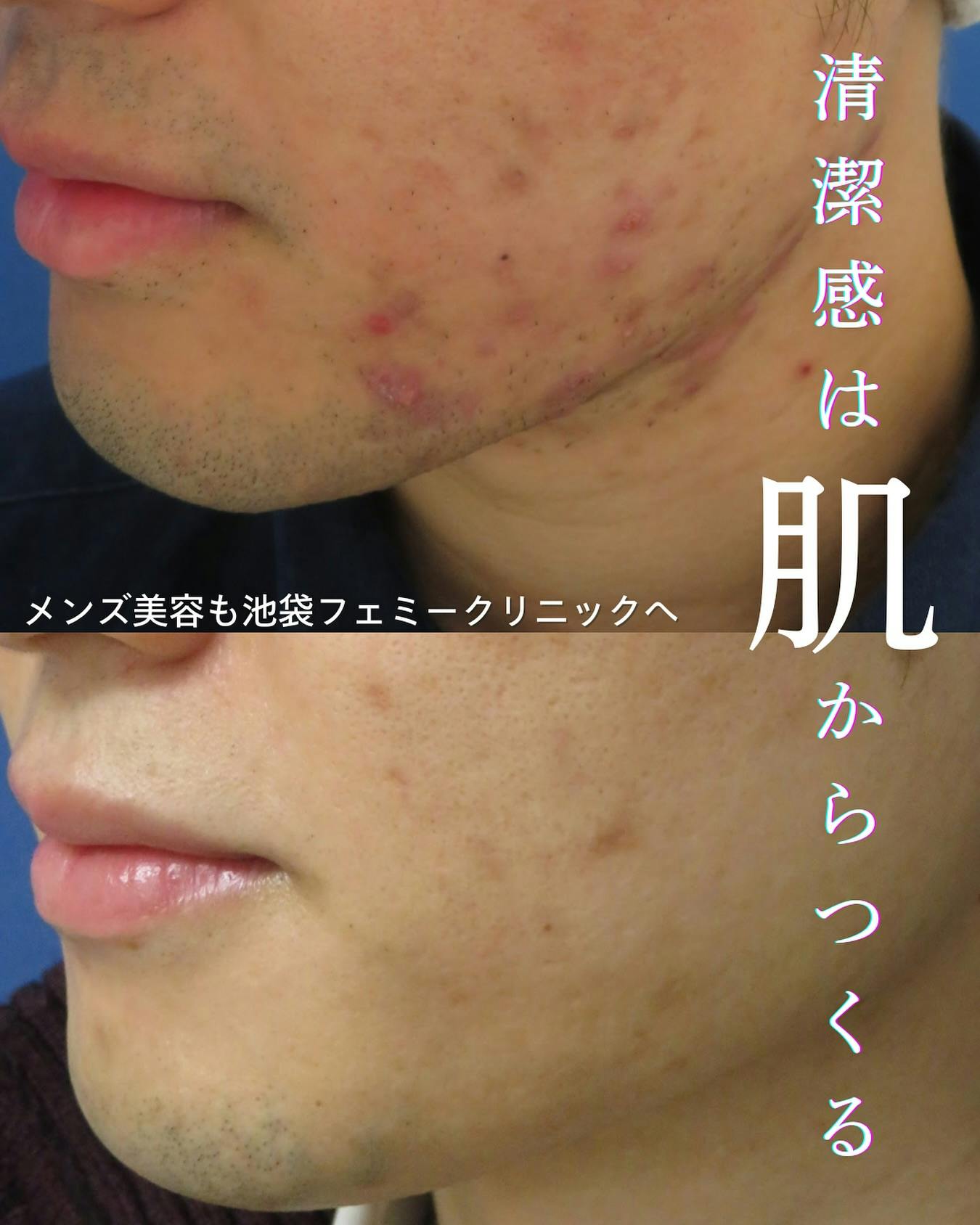 【男性・肌】ニキビ治療_before_aftar