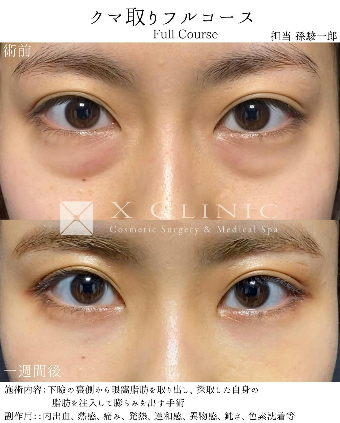 【女性・目元】クマ取りフルコース_before_aftar