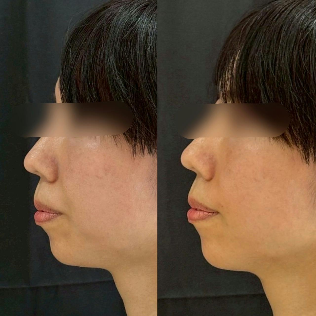 ヒアルロン酸_before_after