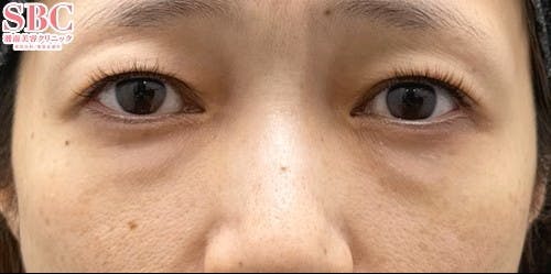 【30代女性・クマ】裏ハムラ法 SBCプレミアムPRP皮膚再生療法_before