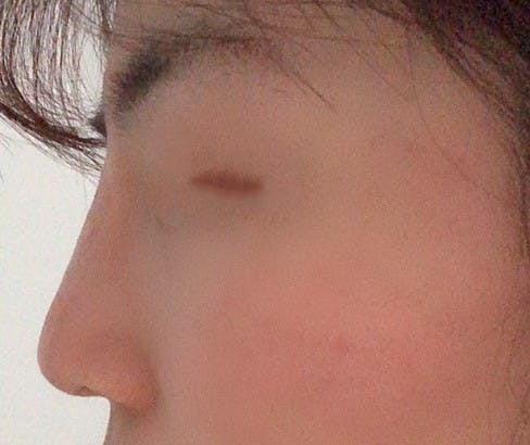 品川スキンクリニック札幌院でヒアルロン酸　鼻根を受けたあやみんさんの写真