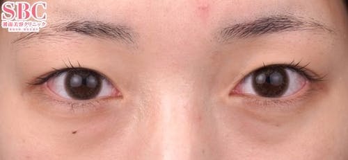 【20代女性・目元】クイックコスメティーク・トリプルNeo_before