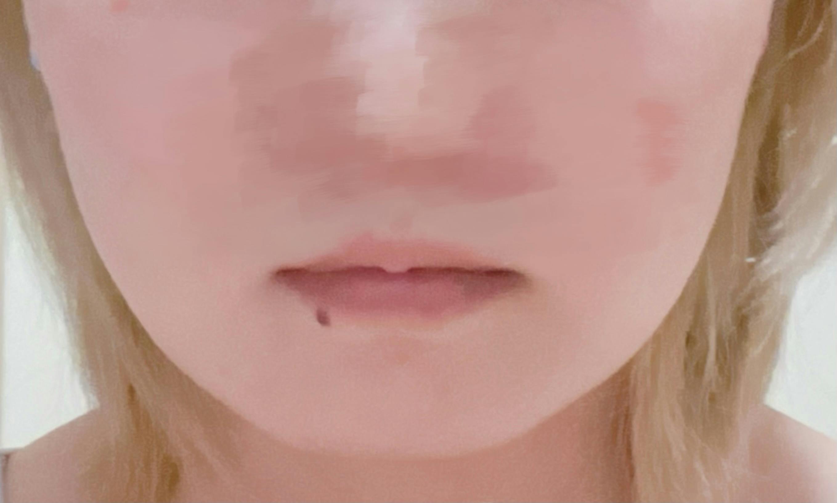 フェイススキンクリニック(FACE SKIN CLINIC)で顎ヒアルロン酸注入(ボラックス)を受けたumさんの写真