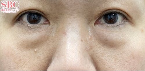 【女性・目元】目の下の切らないクマ・たるみ（ふくらみ）取り、ナチュラル脂肪注射コンデンスリッチ、ナチュラル脂肪注射ナノリッチ_before