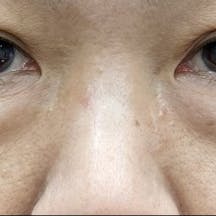 【女性・目元】目の下の切らないクマ・たるみ(ふくらみ)取り、ナチュラル脂肪注射コンデンスリッチ、ナチュラル脂肪注射ナノリッチ_before