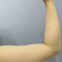 【女性・二の腕】美ボディ脂肪吸引_before