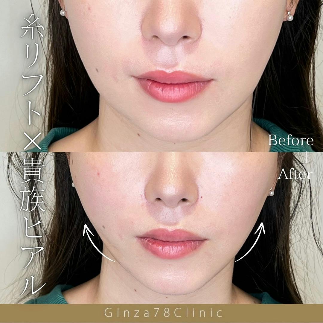 【女性・小顔】糸リフト_before_aftar