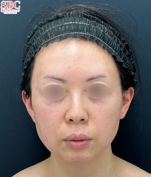 【40代女性・顔】小顔用脂肪吸引注射・バッカルファット除去・糸リフト_before