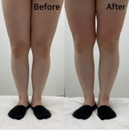 【女性・膝上】エリクサーカット_before_aftar