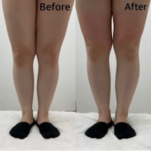 【女性・膝上】エリクサーカット_before_aftar