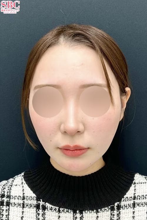 【20代女性・顔】小顔用脂肪吸引注射・糸リフト・その他の治療法_after