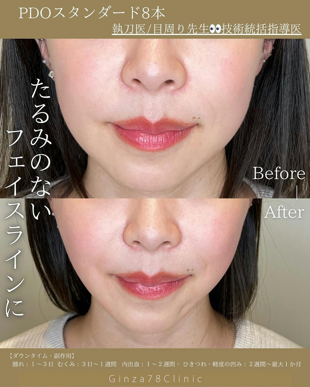 【女性・たるみ】糸リフト(PDOスタンダード)_before_aftar