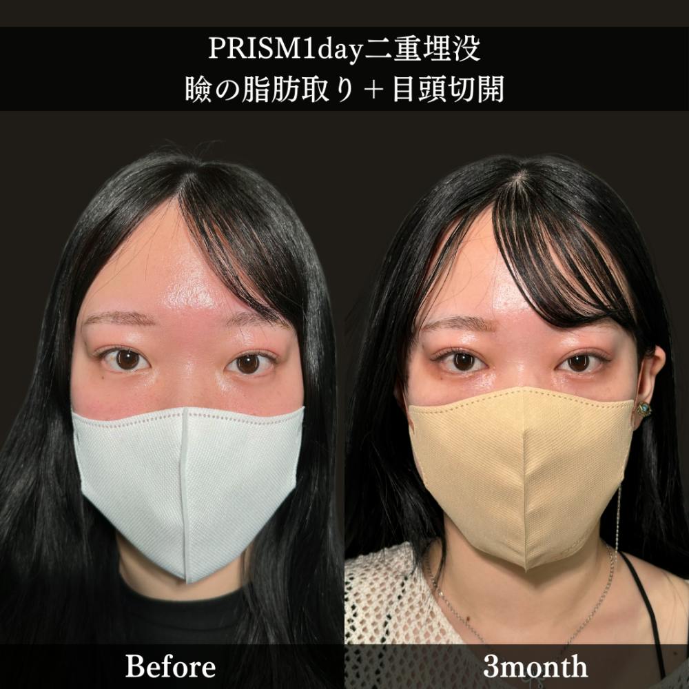 【20代女性・目】PRISM 1day二重埋没＋まぶたの脂肪取り＋目頭切開Z法_before_aftar
