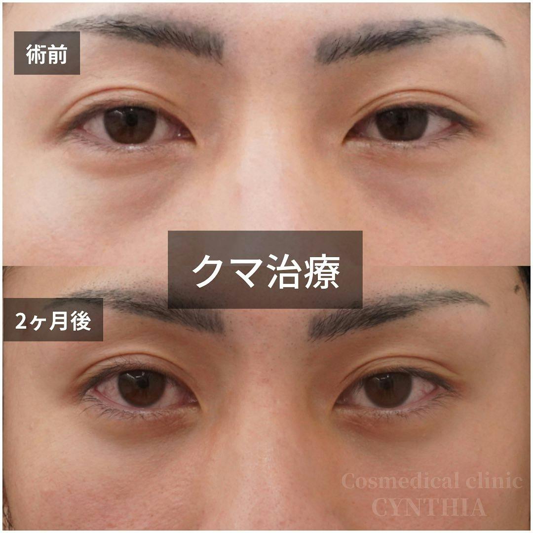 【20代男性・目元】目の下のクマ取り_before_aftar
