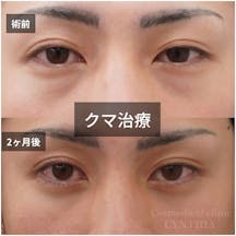 【20代男性・目元】目の下のクマ取り_before_aftar