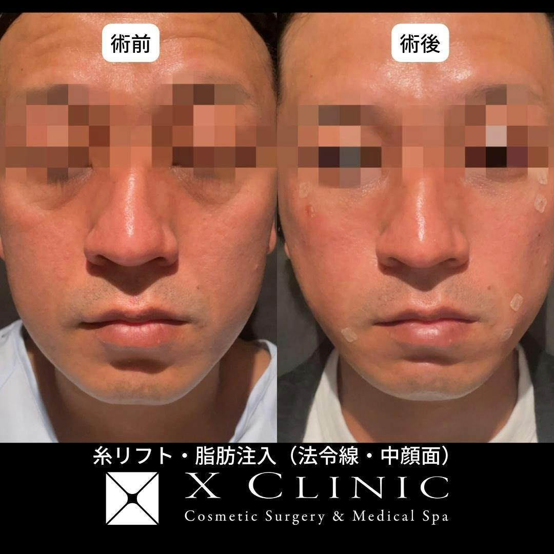 【男性・輪郭】糸リフト(Ｘスレッド)＋脂肪注入(目の下・ゴルゴ線・法令線)_before_aftar