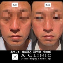 【男性・輪郭】糸リフト(Xスレッド)+脂肪注入(目の下・ゴルゴ線・法令線)_before_aftar